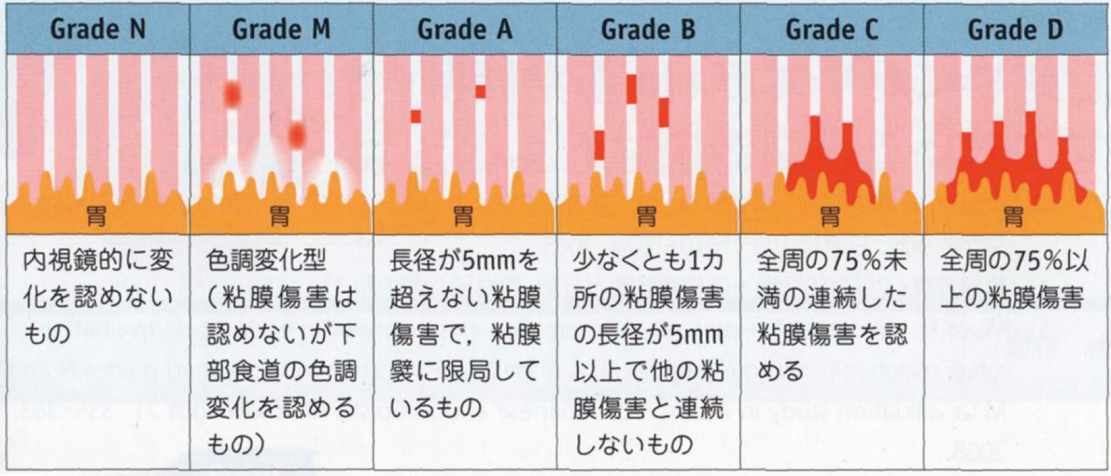 性 グレード 炎 逆流 食道 食道胃接合部が語るもの その①