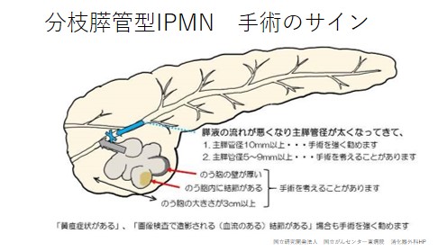 分枝膵管型IPMN　手術のサイン
