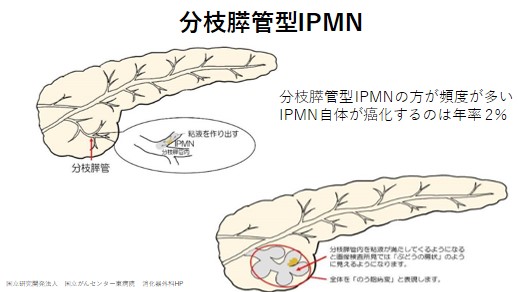 分枝膵管型IPMN