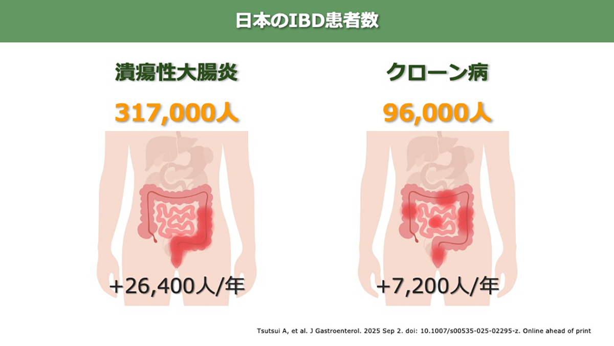 日本のIBD患者数