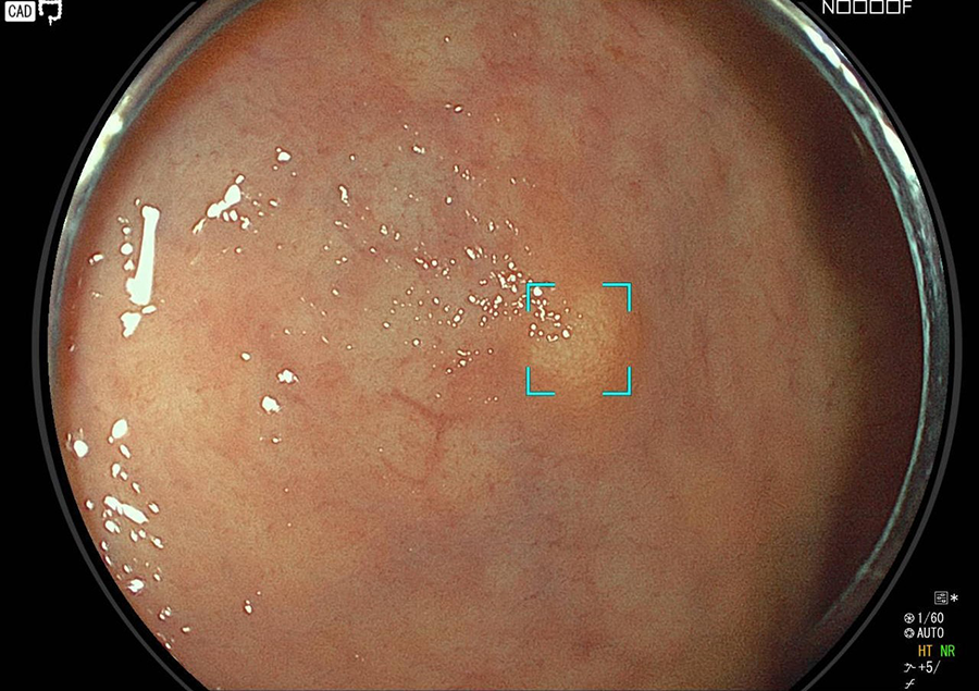 カルチノイド腫瘍