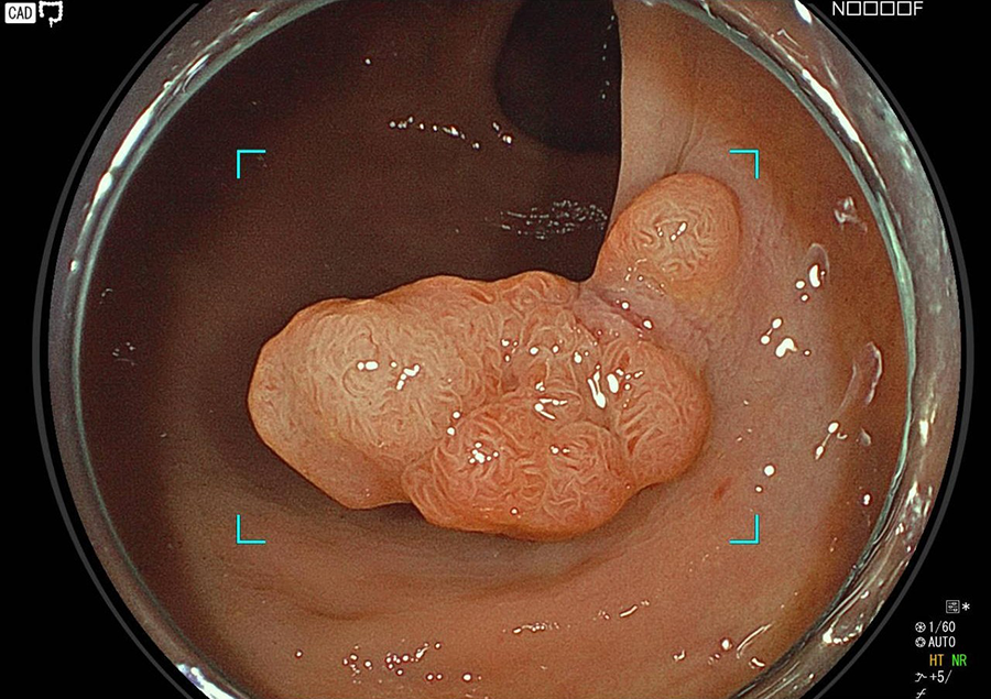 大腸内視鏡ポリープ切除術の様子