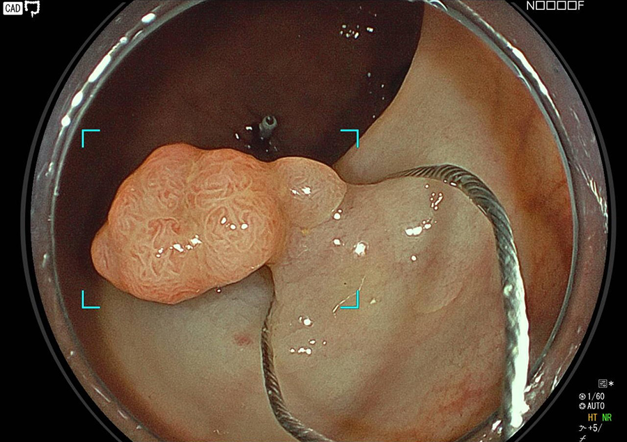 大腸内視鏡ポリープ切除術の様子