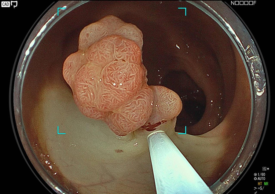 大腸内視鏡ポリープ切除術の様子