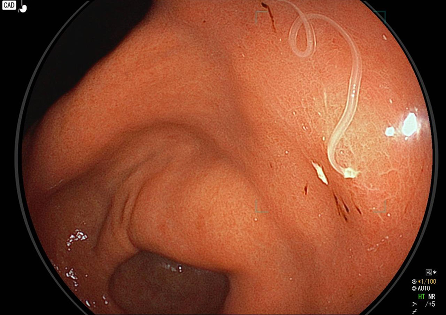 胃アニサキス症