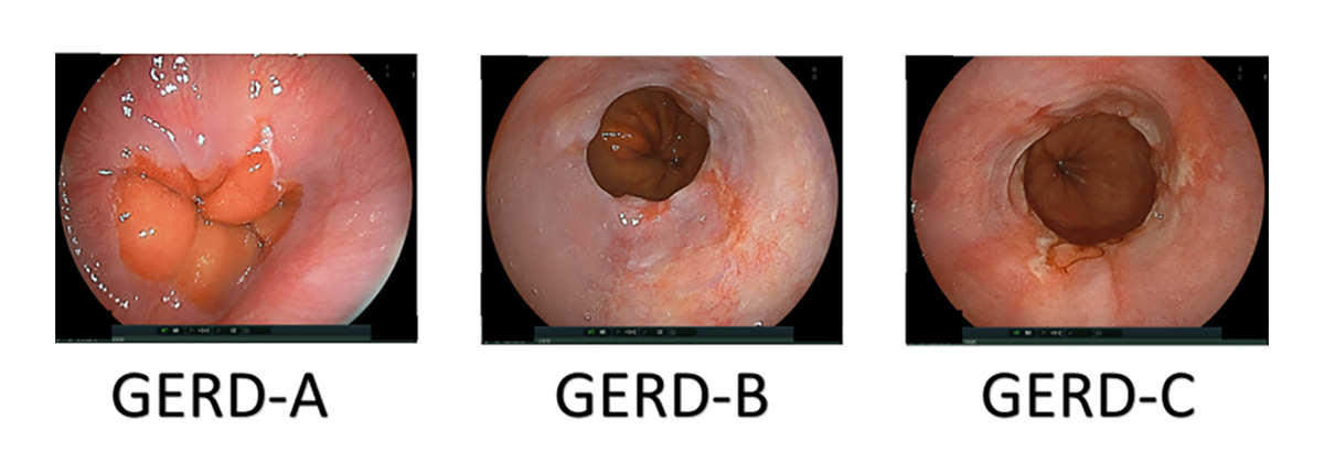 胃食道逆流症（GERD）の分類