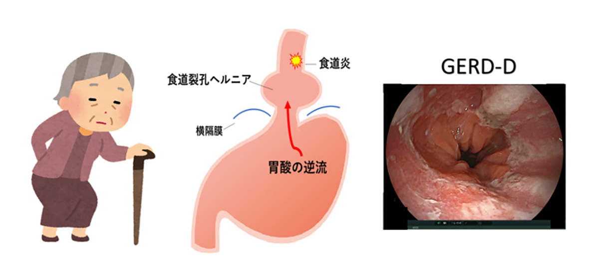 高齢者の胃食道逆流症の原因