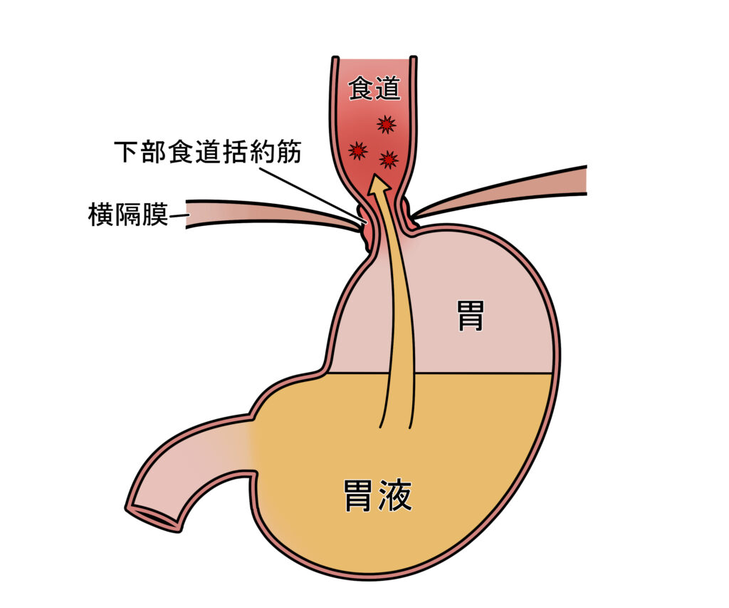 胃酸、逆流性食道炎