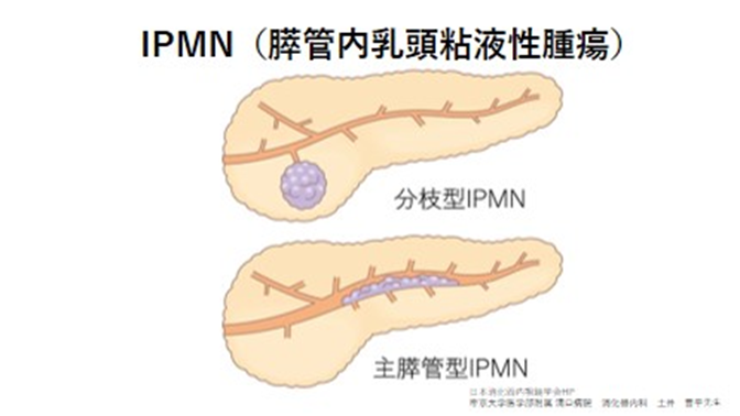 IPMN
膵管内乳頭粘膜性腫瘍