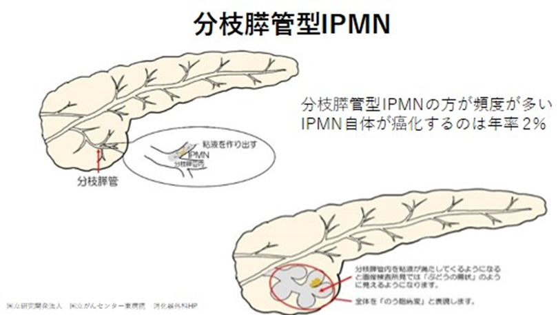 分枝膵管型IPMN