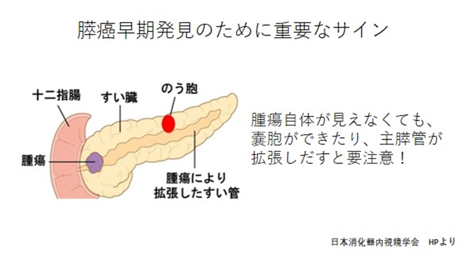 膵癌早期発見のために重要なサイン